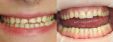 Dentální centrum - MUDr. Rafael Chajrušev Zubné výplne 