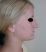 Operácia nosa (Rhinoplastika)