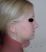 Operácia nosa (Rhinoplastika)