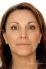 Esthelis, Restylane, Juvéderm, Surgiderm, Teosyal, Matridex, Matridur (preparáty kyseliny hyaluronovej)