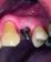 Zubné implantáty