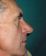Operácia nosa (Rhinoplastika)