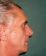Operácia nosa (Rhinoplastika)
