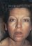 Operácia obočia (Brow lift)