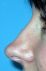Operácia nosa (Rhinoplastika)