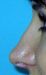 Operácia nosa (Rhinoplastika)