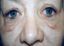 Operácia očných viečok (Blepharoplastika)  