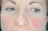 Fotorejuvenizácia /Resurfacing