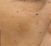 Fotorejuvenizácia /Resurfacing