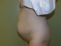 Abdominoplastika (Operácia brucha)