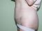 Abdominoplastika (Operácia brucha)