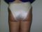 Liposukcia
