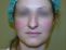 Operácia nosa (Rhinoplastika)
