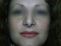 Operácia nosa (Rhinoplastika)