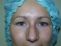 Operácia očných viečok (Blepharoplastika)  