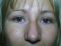 Operácia očných viečok (Blepharoplastika)  
