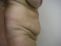 Abdominoplastika (Operácia brucha)