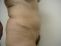 Abdominoplastika (Operácia brucha)