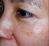 Fotorejuvenizácia /Resurfacing