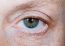 Operácia očných viečok (Blepharoplastika)  