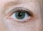 Operácia očných viečok (Blepharoplastika)  