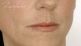 Esthelis, Restylane, Juvéderm, Surgiderm, Teosyal, Matridex, Matridur (preparáty kyseliny hyaluronovej)