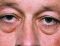 Operácia očných viečok (Blepharoplastika)  