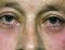 Operácia očných viečok (Blepharoplastika)  