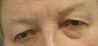 Operácia očných viečok (Blepharoplastika)  