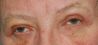 Operácia očných viečok (Blepharoplastika)  