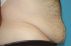Abdominoplastika (Operácia brucha)