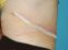 Abdominoplastika (Operácia brucha)