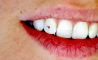 Dentálne klenoty