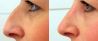Operácia nosa (Rhinoplastika)