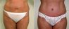 Abdominoplastika (Operácia brucha)